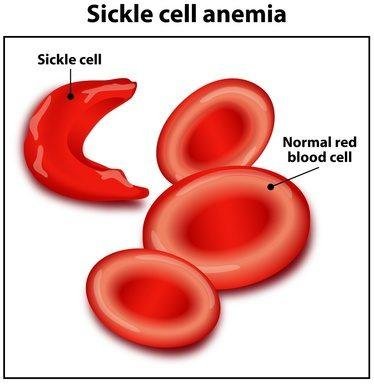Sickle Cell Anaemia